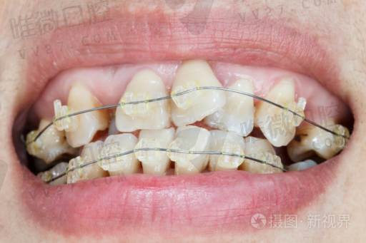 牙科聚羧酸锌水门汀的作用（聚羧酸锌水门汀垫底）(图1)